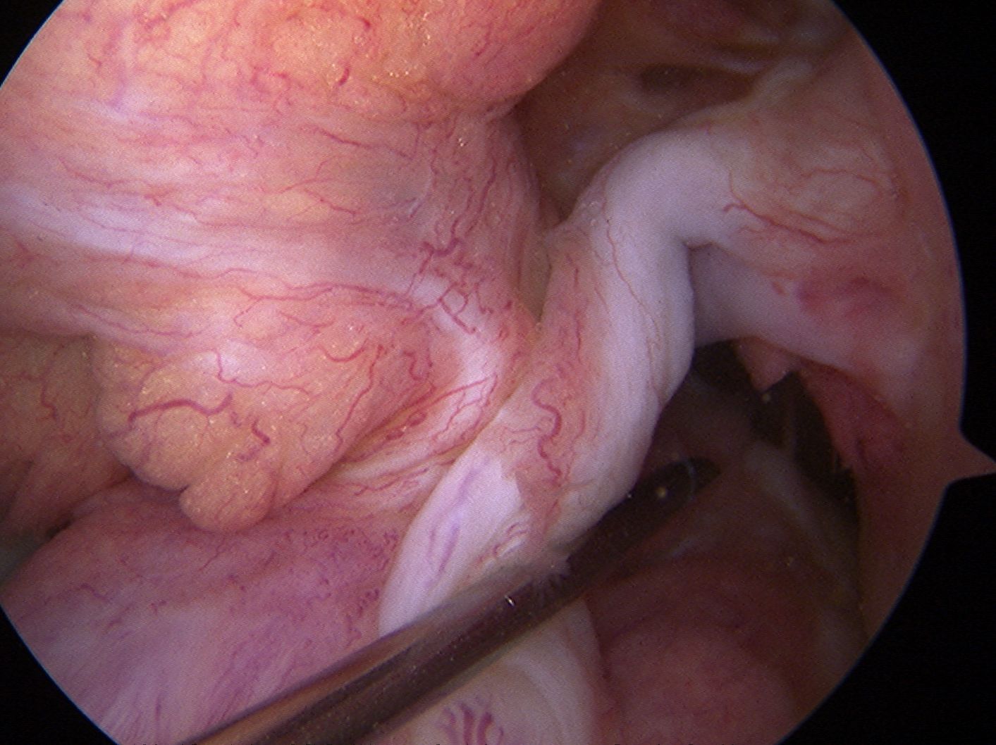 ACL Rupture Empty Lateral Wall